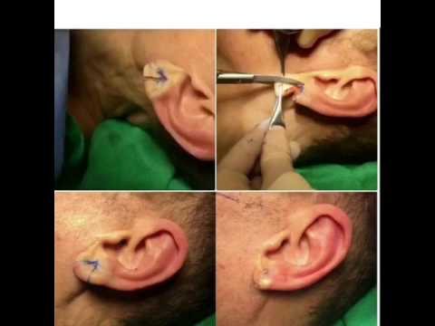 Video: Il piercing al padiglione auricolare fa male?