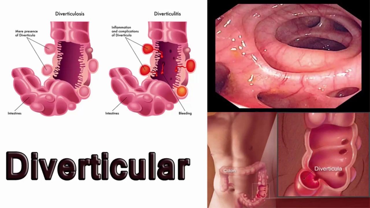 Diverticulitis tratamiento