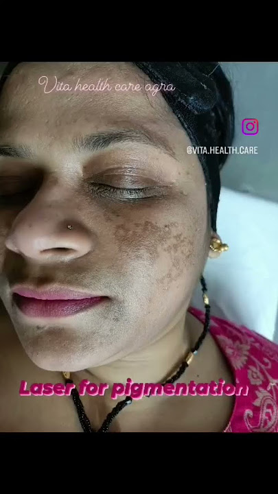 #laser #lasertreatment #pigmentation #pigmentationtreatment #vitahealthcareagra