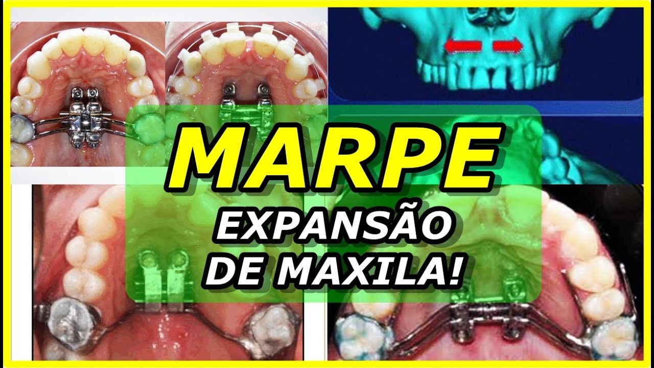 APARELHO ORTODÔNTICO MARPE | COMO FUNCIONA? | A VERDADE REVELADA!