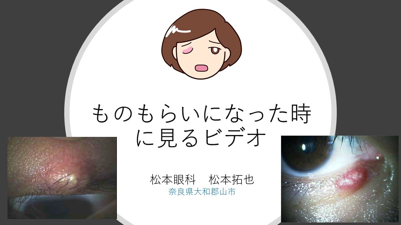 ものもらい 眼科行くべき: ものもらい 一日で治す方法 – IKPUUB