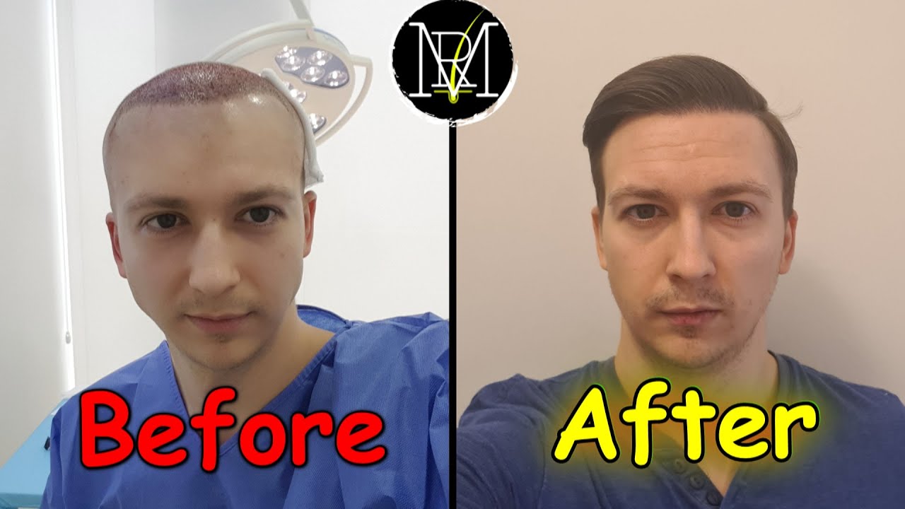 10000 Graft Hair Transplant in Turkey  10000 Grafts Hair Transplant Cost  in Turkey  YouTube