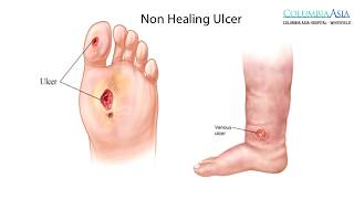 What Are Types Of Non Healing Ulcers & How Should A Diabetic Foot Ulcer Be Treated?