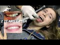 getting my braces off!! *omg crazy*