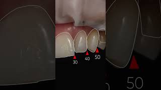 No-prep veneers ❤️‍🔥