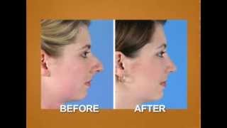 Nose Job Before and After (Rhinoplasty)