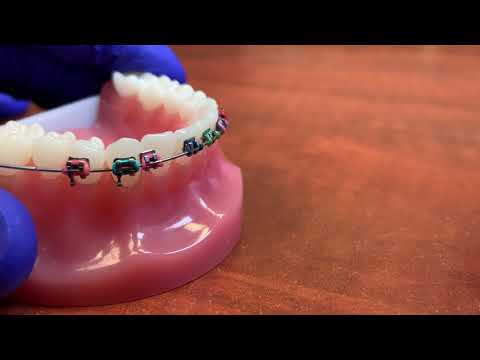 How to remove a broken bracket