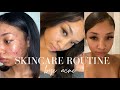 HOW I CLEARED MY SKIN WITH CUROLOGY (not sponsored) | SKINCARE ROUTINE 2021 |