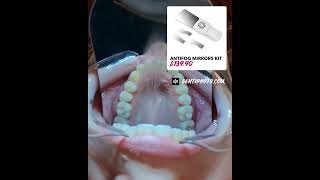 Fog mirror for dental intraoral photography Fog mirror for dental intraoral photography