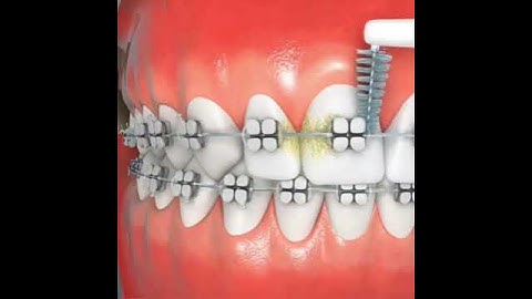 Hướng dẫn vệ sinh răng niềng bằng bàn chải kẽ  #niềngrăng #niềngrăng #niengrang #dentist