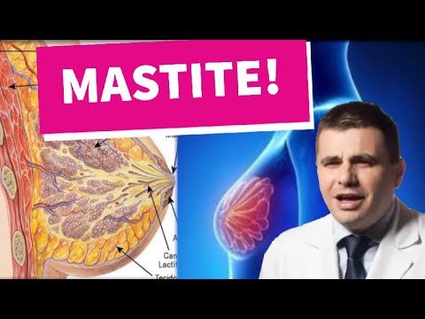 Vídeo: Mastite Purulenta - é Perigosa? Primeiros Sintomas E Tratamento