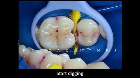 Class 2 composite restoration. #Bioclear #injection_molding