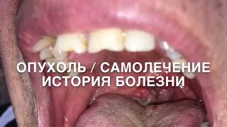 ОПУХОЛЬ / САМОЛЕЧЕНИЕ / История болезни онлайн / Анонс и трейлер