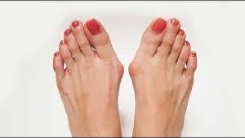 Correction hallux valgus CPT code - simplify medical coding