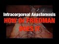 Intracorporeal Anastomosis - How Dr. Garrett Friedman Does It