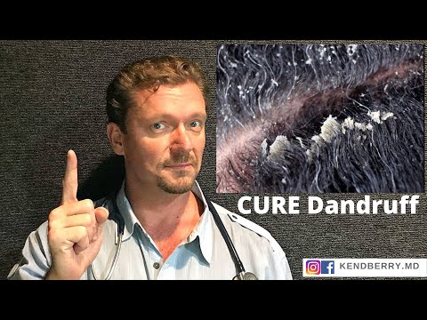 CURE Dandruff (And keep it Gone FOREVER) Seborrhoeic Dermatitis