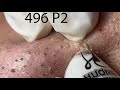 Make Your Acne Treatment Huong Da Nang 496 Acne 2022 Part2 
