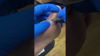 Watch An Aussie Podiatrist Tackle Big Toe Callus Removal With Expertise! #Footcare #Podiatrymagic