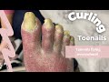 Curling Toenails