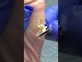 Callus Cutting by Dr Nail Nipper