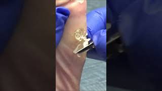 Callus Cutting by Dr Nail Nipper...