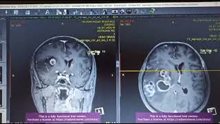 Эпендимома позвоночника причины симптомы лечение - полная информация
