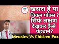 Measles Vs Chicken Pox!  How To Differentiate?? खसरा और चिकन पॉक्स मे क्या फरक होता है? HINDI.