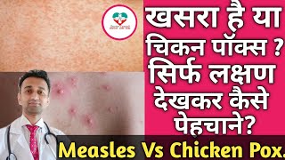 Measles Vs Chicken Pox How To Differentiate Hindi