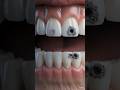 What Happens If You Never Brush Your Teeth? 🦷💀@MrBeast#shorts #teeth #dentalhealth #viralshorts