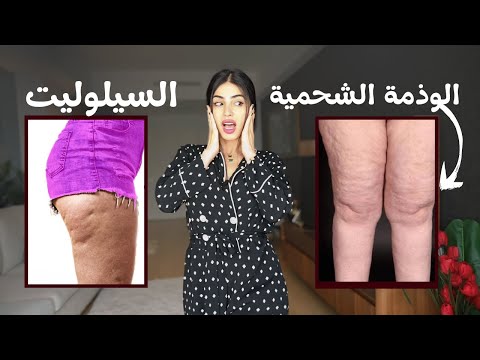 الفرق بين السيلوليت والوذمة الشحمية الأسباب والحلول الفع الة