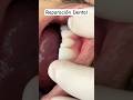 Reparación dental #dentista #dentist #carillas #fracturadental #resinadental