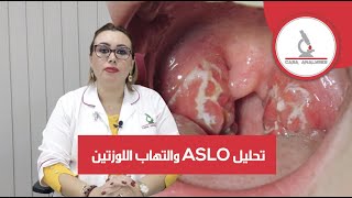 و التهاب اللوزتين  ASLO  تحاليل