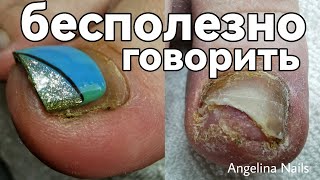 ТРАВМА ногтя / зачистка онихолизиса / гематома на пальце / сложный педикюр на перехоженным покрытием