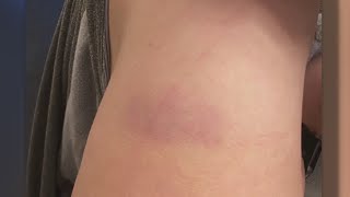 Vaccine Recipients Report ‘COVID Arm’ And Other Side Effects, But Doctors Say Don’t Worry