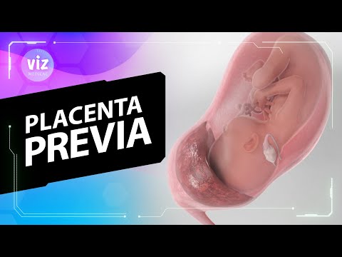 How placenta can block your baby's path (3D Animation) - video from ViewMedica