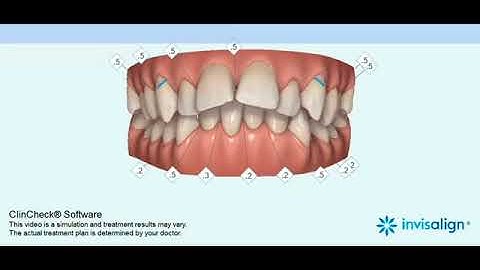 Invisalign ClinCheck at The Gill Clinic