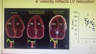 Tissue Doppler in CP
