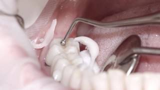 Speedcem Plus Ivoclar Vivadent Video2