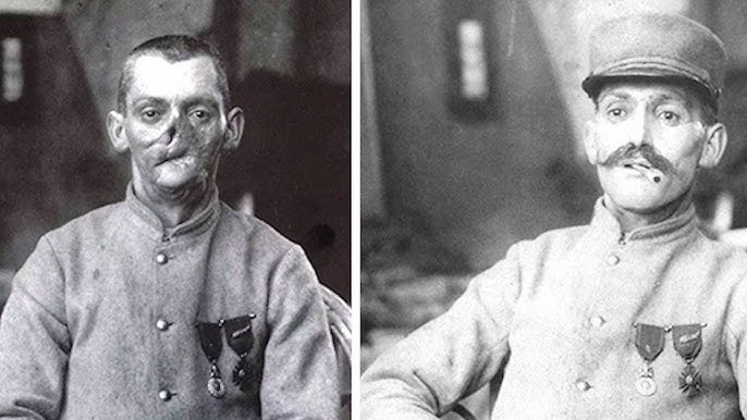 World War 1 Shell Shock Victim Recovery (1910s)