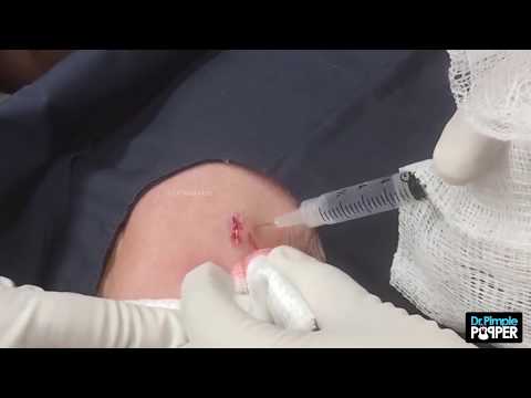 A Small Excision Of A Cyst On The Left Cheek