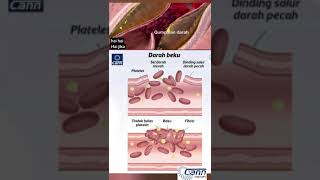 # CANN SIHAT ( AWAS SALURAN DARAH TERSUMBAT ).