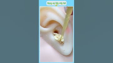 👂✨ Cây Vệ Sinh Tai An Toàn Và Tiện Lợi – Lựa Chọn Cho Cả Gia Đình! ✨🧴  #giadungtienich #xuhuong