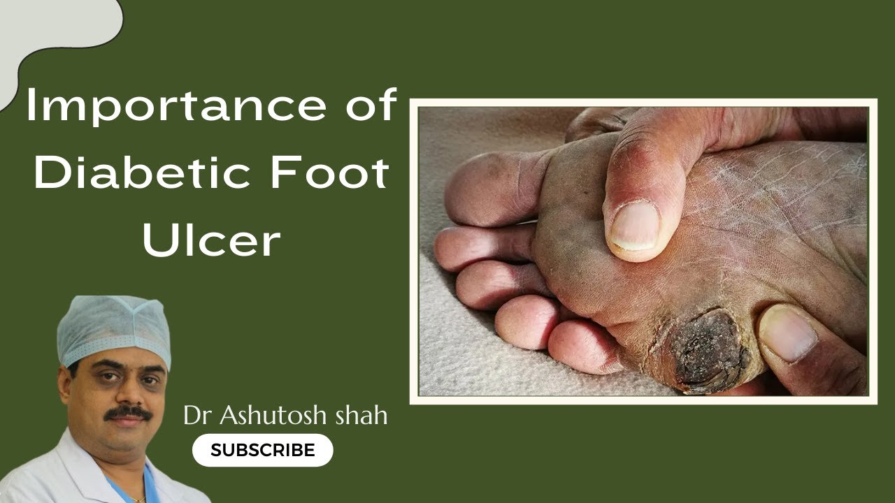 What Is The Importance of Diabetic Foot Ulcer Treatment, prevention