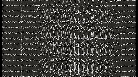 EEG for an Intensivist - Dr Sandeep Nayani