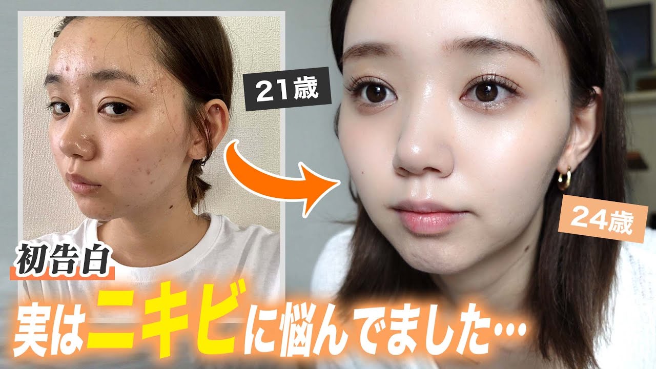 江野沢愛美 ニキビ肌に悩んだ過去初告白 当時と現在の比較写真も公開 悩んでるみんなの背中押せたら嬉しい モデルプレス 江野沢愛美 ニキビ肌に悩んだ過去初告白 当時と現在の比較写真も公開 悩んでるみんなの背中押せたら嬉しい モデルプレス