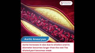 Bentall Procedure: Aortic Aneurysm Repair and Heart Health