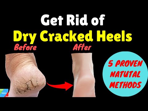 How to Get Rid of Cracked Heels? – Shoprythm