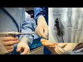 Great toe joint fusion with Treace Medical’s SpeedMTP
