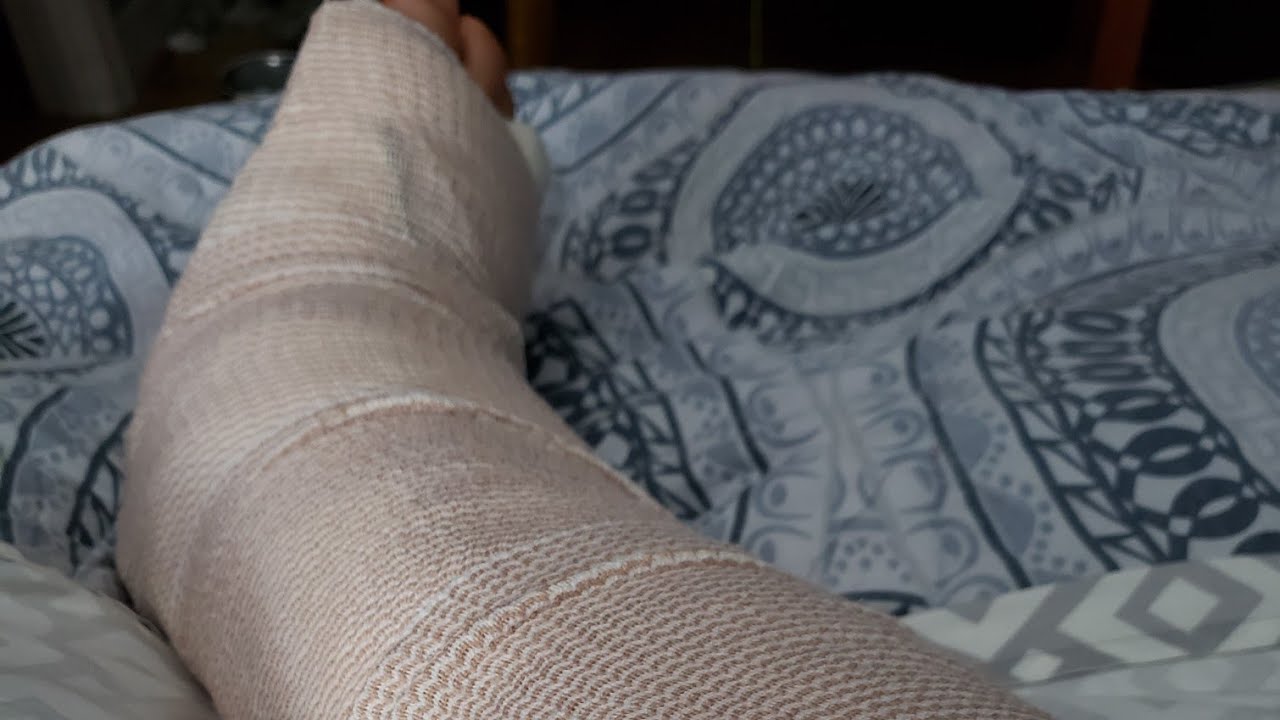 Broken leg tib fib fracture - YouTube