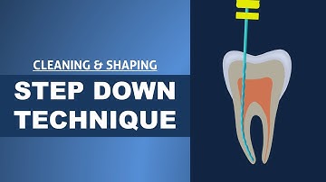 Step Down Technique | Cleaning and Shaping